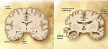 Comparación entre un cerebro normal y un cerebro afectado por Alzhéimer. Imagen: COMPARISONSLICE_HIGH.JPG. Fuente: Wikipedia.