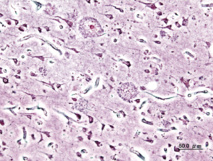 Imagen histopatológica de placas seniles vista en la corteza cerebral de un paciente con la enfermedad de Alzheimer. Imagen: User:KGH. Fuente: User:KGH.
