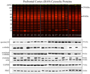 Perfiles de proteínas de la corteza prefrontal. Las muestras de sujetos alcohólicos muestran una reducción importante en las proteínas. Fuente: UPV-EHU.