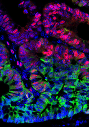 Imagen de un tumor benigno de colon. En verde, células madre del adenoma. Los científicos han descubierto que el colon tiene un mecanismo de seguridad para evitar que las células madre del adenoma se autorrenueven Fuente: Laboratorio de Cáncer Colorrectal.