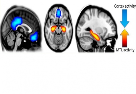Actividad cerebral bajo el efecto de la psilocibina, con una reducción (en azul) de la actividad en las regiones cerebrales evolutivamente avanzadas, y una reducción (en naranja) en los centros de memoria y emoción. Fuente: Imperial College de Londres.