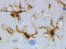 Microglías, uno de los tipos de células de los que se ha conseguido eliminar el virus del sida mediante edición del ADN. Fuente: Wikipedia.