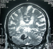 Resonancia magnética de un ictus. Imagen: Bobjgalindo. Fuente: Wikipedia.