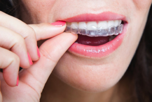 Los 'alineadores' creados en Argentina. Fuente: CTyS. Los 'alineadores' creados en Argentina. Fuente: CTyS.