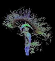 Reconstrucción tractográfica de las conexiones neurales a través de imagen por resonancia magnética. Fuente: Wikimedia Commons.