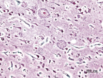 Imagen de las placas seniles (depósitos extracelulares de beta-amiloide en la sustancia gris del cerebro) de un paciente con Alzheimer. Imagen: KGH. Fuente: Wikimedia Commons.