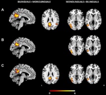Áreas del cerebro activadas en bilingües y en monolingües. Fuente: UPF. Áreas del cerebro activadas en bilingües y en monolingües. Fuente: UPF.