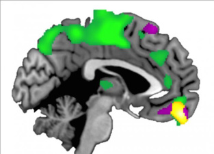 El córtex prefrontral ventromedial (amarillo) es mayor en aquellos que confían más en los demás. Imagen: Brian Hass. Fuente: Universidad de Georgia.
