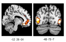 La imagen muestra una actividad incrementada en los cerebros de los portadores de la variante por delación del gen ADRA2b. Fuente: UBC.