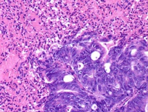 Células tumorales en un cáncer de páncreas. Fuente: Universidad de Michigan (EEUU). Células tumorales en un cáncer de páncreas. Fuente: Universidad de Michigan (EEUU).