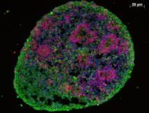 ‘Cerebros’ en miniatura hechos con células de piel revelan nuevos datos sobre el autismo