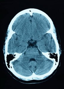 Los transexuales operados apenas sienten el síndrome del miembro fantasma Los transexuales operados apenas sienten el síndrome del miembro fantasma