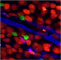 Linfocitos-T (en verde) cazando células tumorales (en rojo). Fuente: Universidad de Radboud/Alphagalileo.