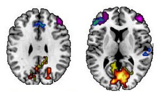 Zonas de la memoria semántica (azul, verde y morado) y de la memoria episódica (rojo, amarillo y naranja). Fuente: Instituto de Investigación Rotman.