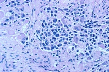 Vista microscópica de células de un ganglio nervioso con neuroblastoma. Fuente: Wikimedia Commons.