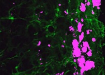 Células reprogramada (verde) cazan y matan células del glioblastoma (rosa). Fuente: UNC.