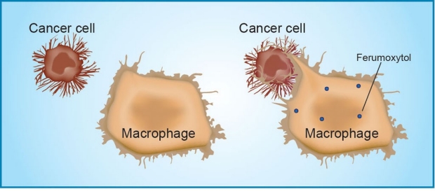 El ferumoxytol activa los macrófagos asociados con los tumores. Imagen: Amy Thomas. Fuente: Universidad Stanford.
