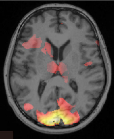 Escáner cerebral que muestra información asociada con un recuerdo de miedo. Imagen: Ai Koizumi. Fuente: Universidad de Cambridge.