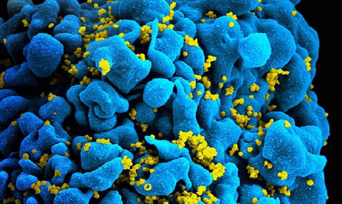 Partículas de VIH infectando a un linfocito T. Imagen: National Institutes of Health (NIH). Fuente: UCM.