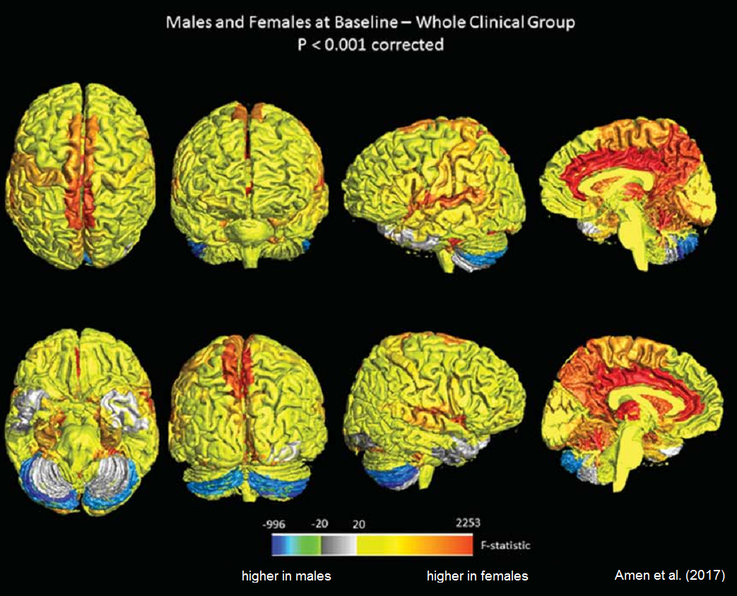 Diferencias de la actividad del cerebro de hombres y mujeres saludables en estado de descanso y de concentración. El color rojo representa la parte más activa de las mujeres, el azul de los hombres. /Journal of Alzheimer’s Disease 2017