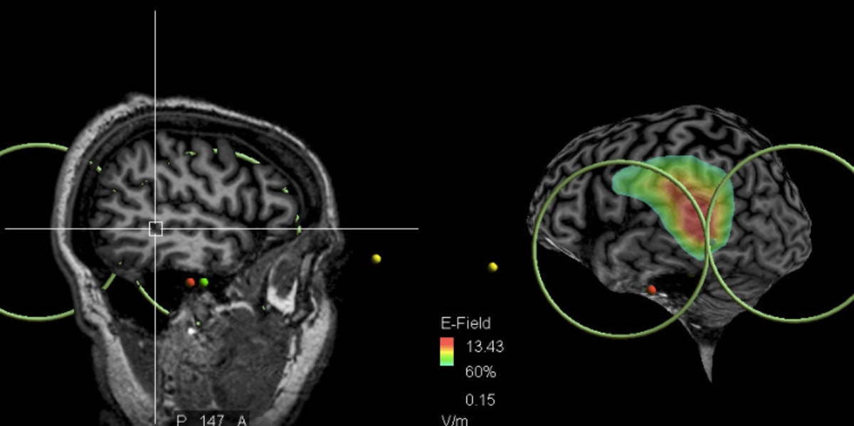 La zona del cerebro impliaca en las voces que oyen los esquizofrénicos. Foto: Universidad de Caen.