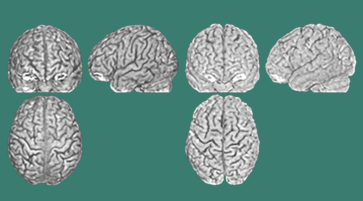 Tres escaneos cerebrales (de la parte frontal, lateral y superior) de dos cerebros diferentes (representados a la izquierda y a la derecha) que pertenecen a gemelos. Los surcos y las crestas son diferentes en cada persona.  Imagen: Lutz Jäncke, UZH