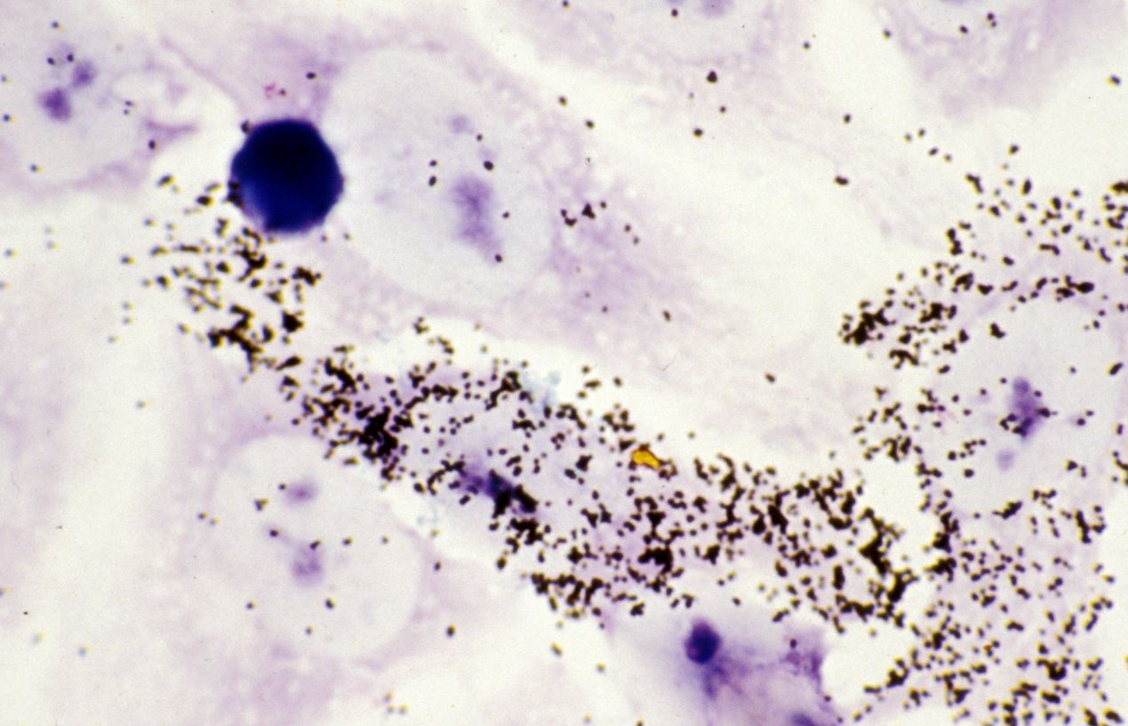 Hibridación in situ del ARN del VIH en las células inmunitarias infectadas. Imagen: Inserm.