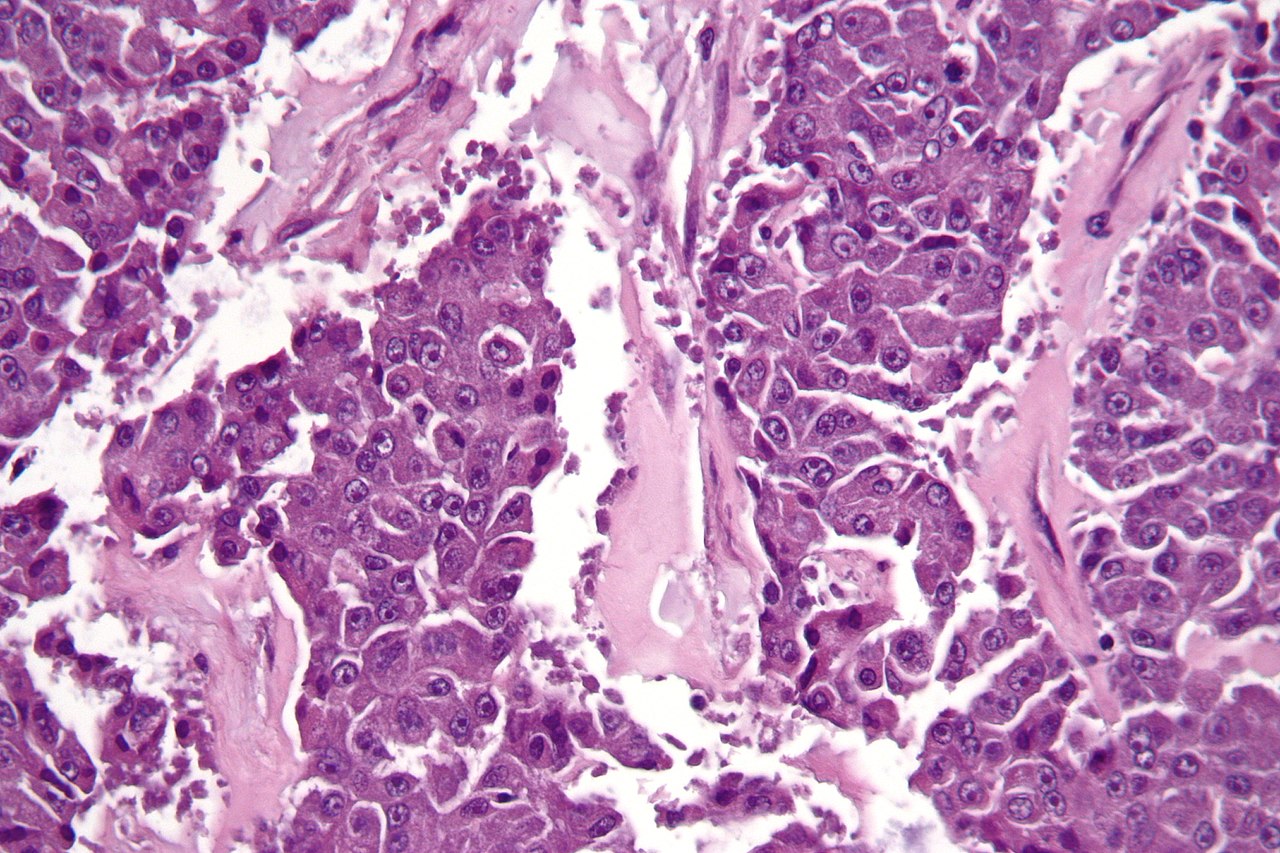 Carcinoma de células acinares del páncreas. Imagen: Wikimedia Commons.
