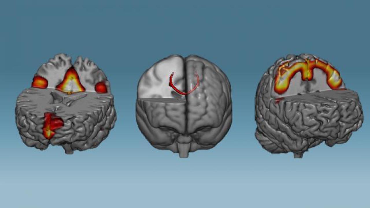 Las redes neuronales que mostraron una mayor conectividad después de una hora de neurofeedback: redes en modo predeterminado (izquierda), cuerpo calloso (medio) y redes sensoriomotoras (derecha).Imagen: Instituto D'Or de Pesquisa e Ensino (IDOR).