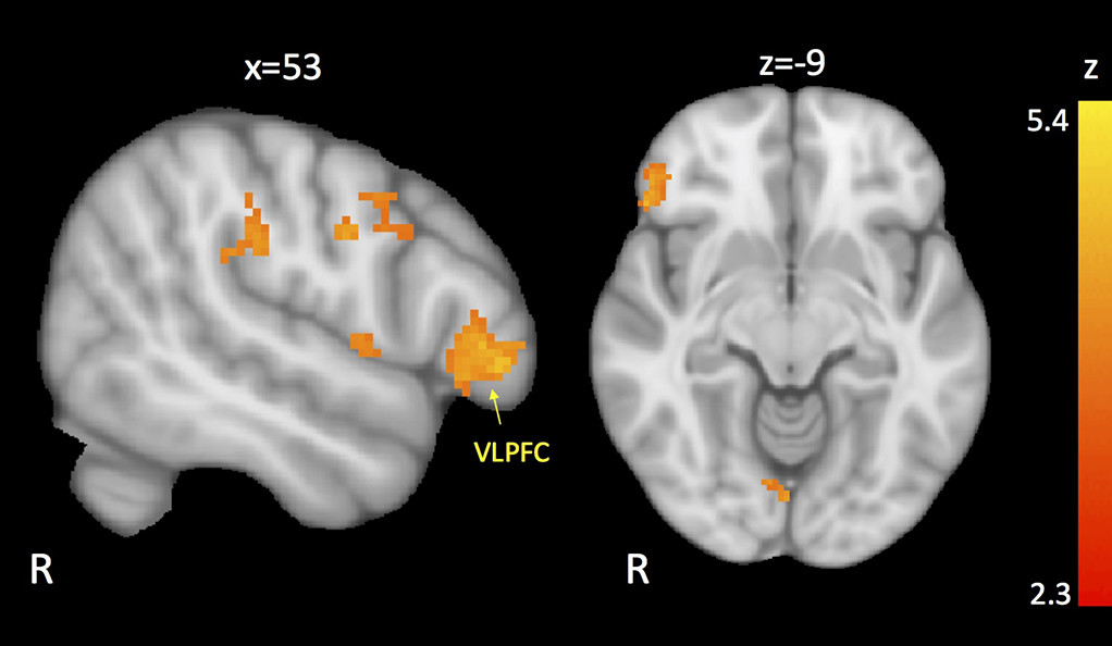 Regiones del cerebro con conectividad reducida a la amígdala. Recreación basada en la media de resultados de los participantes con autismo y comportamiento disruptivo. Imagen: Karim Ibrahim / Sukhodolsky Lab.