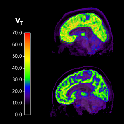 Los cerebros de individuos con trastorno de estrés postraumático y pensamientos suicidas (arriba) muestran niveles más altos de mGluR5 en comparación con los individuos sanos (abajo). Yale University.