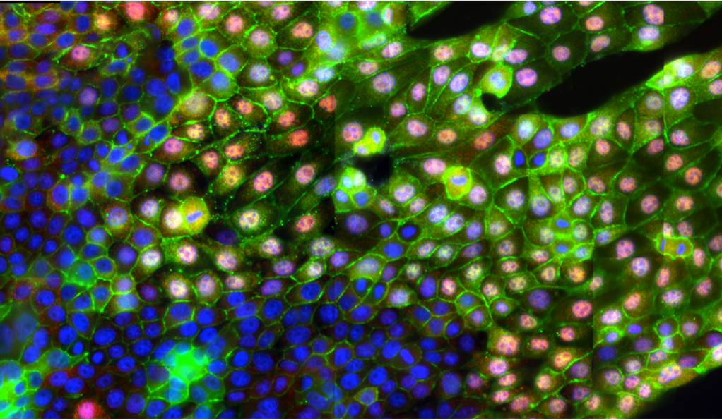 Las células cancerosas pueden iniciar un proceso que las pone en movimiento,  cambiando la actividad de muchas moléculas, de manera similar a un interruptor. Se muestran las proteínas YAP (en rojo) y Catenina beta (en verde), y núcleos celulares (en azul). (Imagen cortesía del laboratorio Levchenko.)