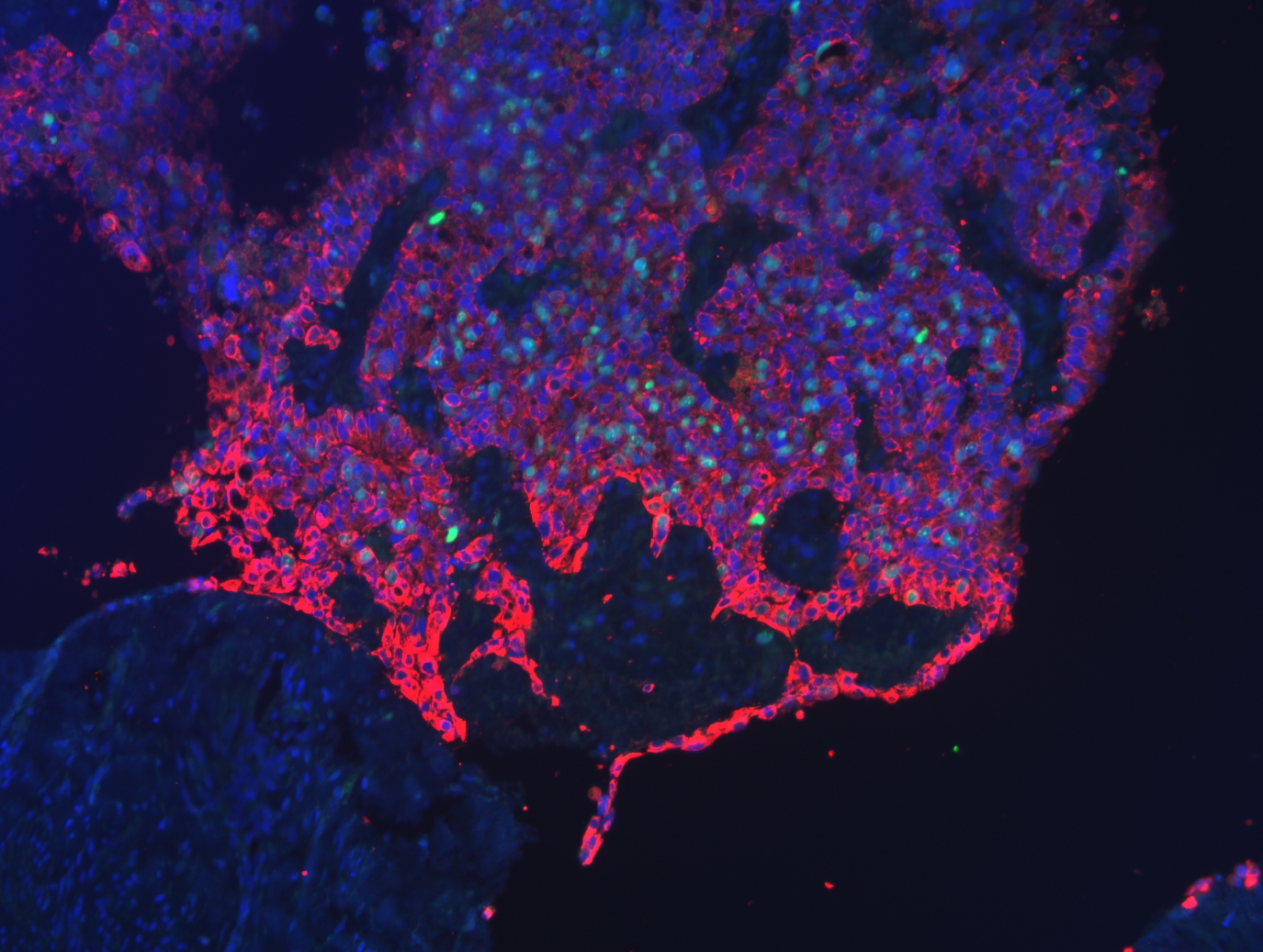 Imagen de la fluorescencia de un tumor delante del cuello uterino. Los núcleos celulares se muestran en azul y las células que se están dividiendo aparecen en verde. Las células tumorales, marcadas en rojo, se infiltran y suprimen el tejido sano. Foto: Hospital Universitario de Leipzig.