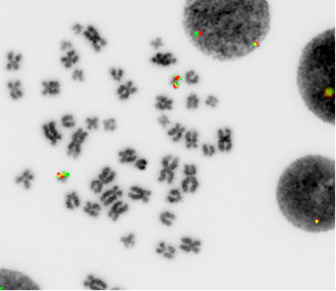 Detección de fusión ETO2-GLIS2 en células leucémicas de pacientes. La señal roja corresponde al locus ETO2, la señal verde corresponde al locus GLIS2 y la señal amarilla indica la presencia de la fusión ETO2-GLIS2. © Thomas Mercher, Inserm.