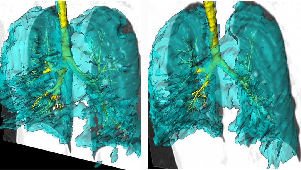 Imagen de los pulmones de dos gemelos con asma: tienen idénticos defectos de ventilación en el mismo segmento pulmonar izquierdo, que permanecieron invariables durante los siete años que duró la investigación. Crédito: Schulich Medicina y Odontología