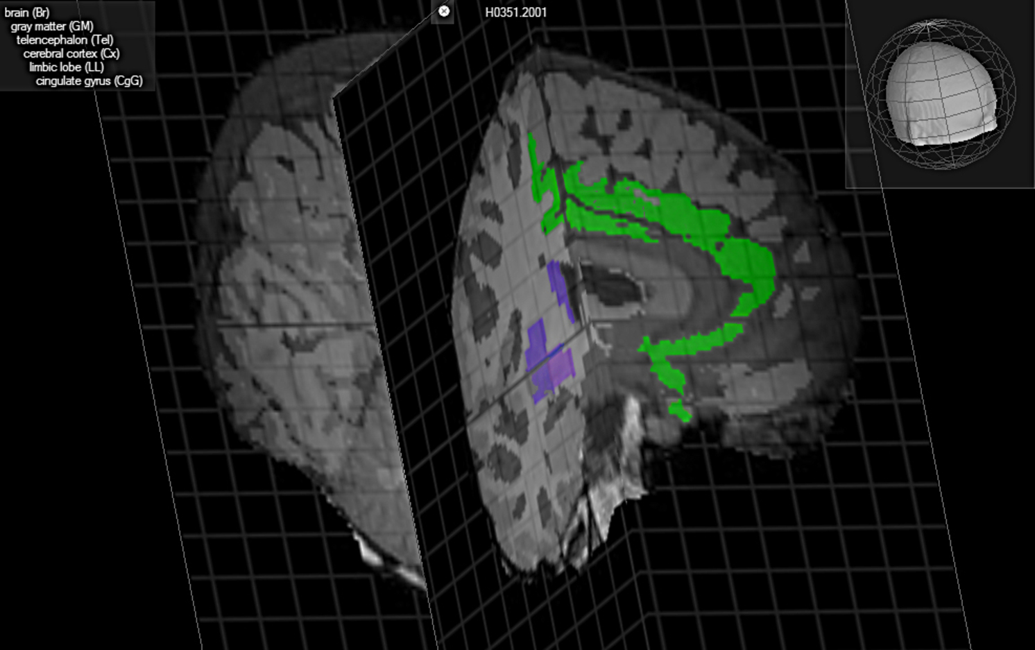 En esta representación del cerebro, aparece en azul la ubicación del claustrum, posible eslabón perdido de la consciencia. Brain Explorer, Allen Institute for Brain Science.