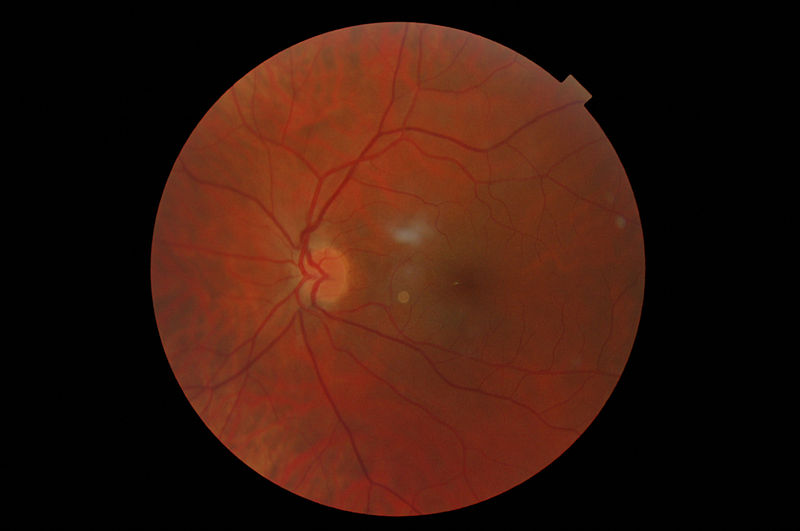 Imagen de fondo de ojo obtenida a través de un oftalmoscopio. Imagen: DavidHardman. Fuente: Wikipedia.