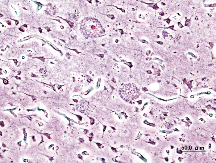 Imagen de las placas seniles (depósitos extracelulares de beta-amiloide en la sustancia gris del cerebro) de un paciente con Alzheimer. Imagen: KGH. Fuente: Wikimedia Commons.