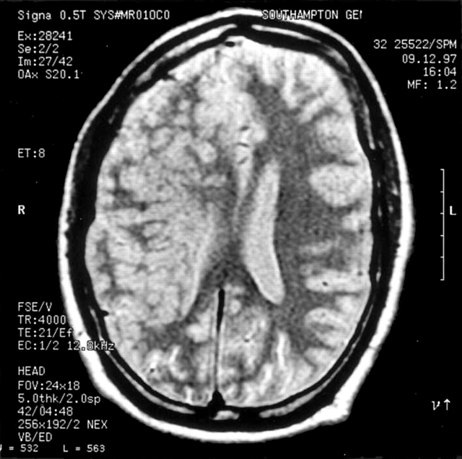 Cerebro de un paciente que parece haber perdido ambas copias del gen BRCA1. Fuente: BMJ.