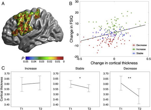 Correlación entre el CI y el grosor de la corteza cerebral. Fuente: NeuroImage/UPF.