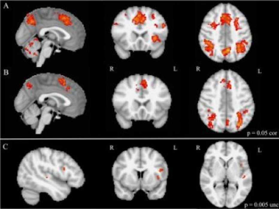 Imágenes de resonancia magnética funcional durante el cambio de tarea mental: Las filas A y B muestran la activación del cerebro en niños musicalmente entrenados y no entrenados, respectivamente. La fila C muestra las áreas del cerebro más activas en niños musicalmente capacitados que en niños no entrenados musicalmente. Fuente: Laboratories of Cognitive Neuroscience del Hospital Infantil de Boston.