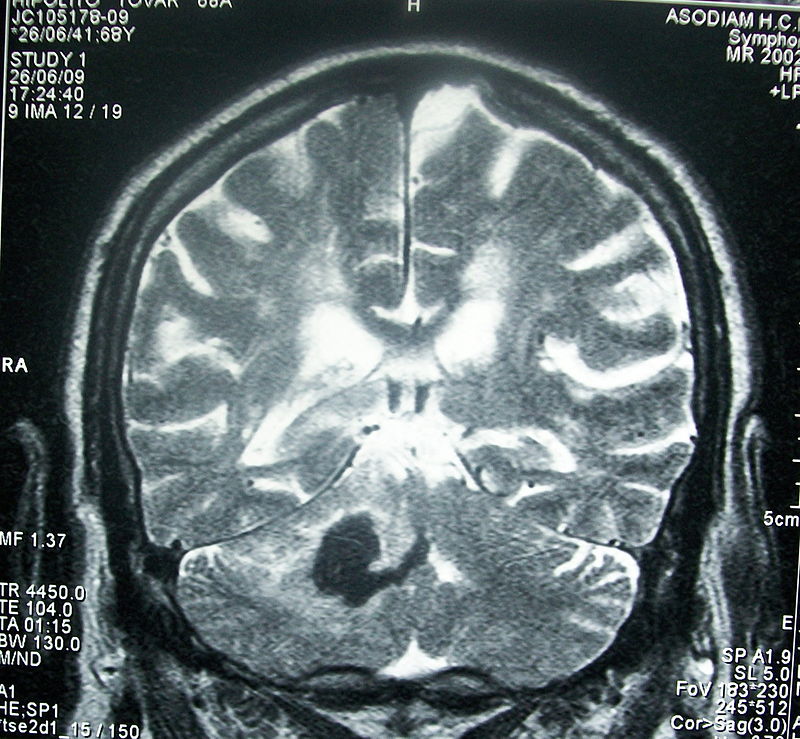 Resonancia magnética de un ictus. Imagen: Bobjgalindo. Fuente: Wikipedia.