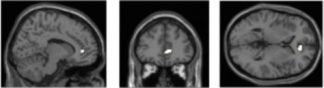La densidad de materia gris en el córtex del cíngulo anterior está relacionada con la exposición a múltiples dispositivos multimedia. Fuente: Universidad de Sussex.