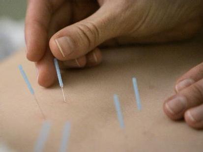 La acupuntura es más eficaz para los dolores lumbares