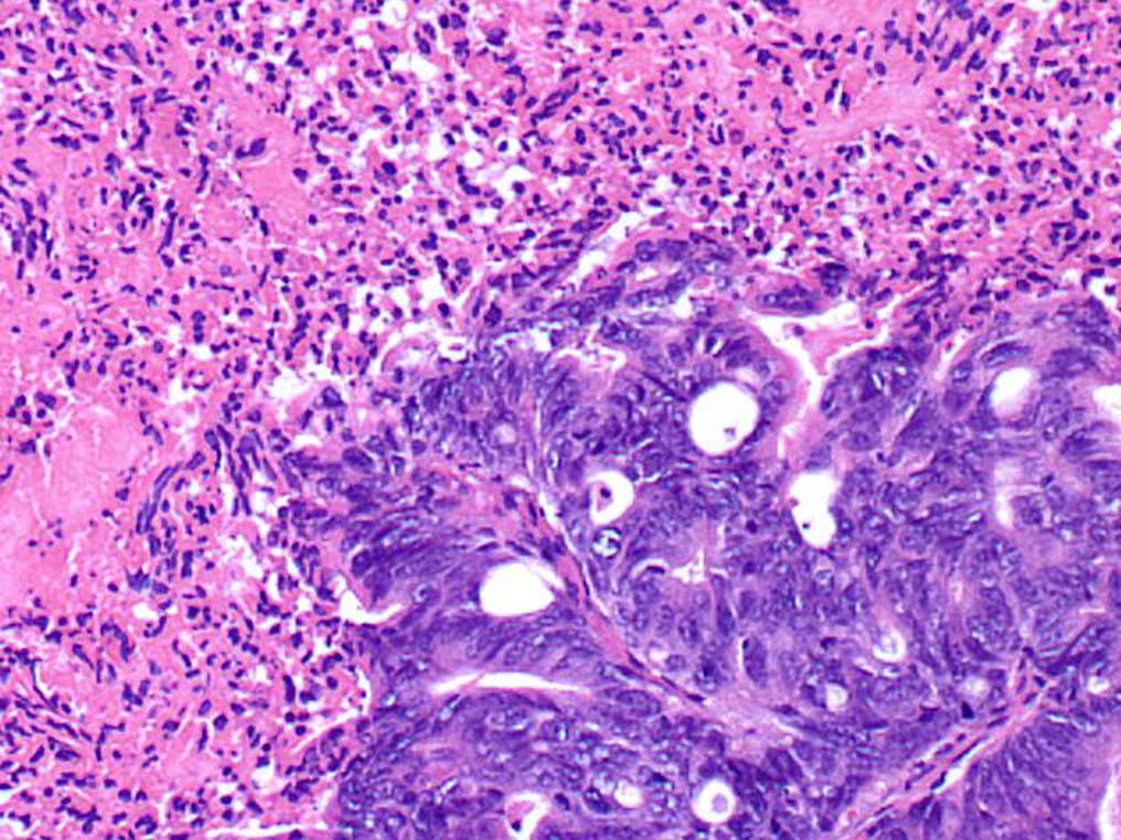 Células tumorales en un cáncer de páncreas. Fuente: Universidad de Michigan (EEUU).