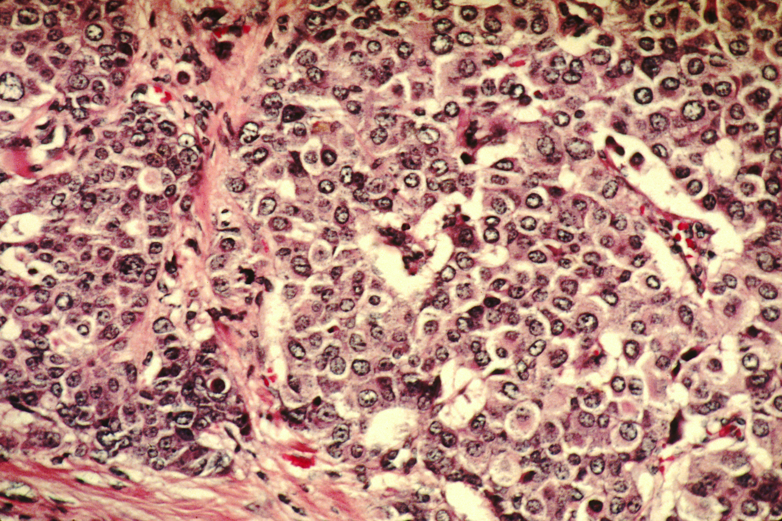 Células de cáncer de mama. Fuente: Wikipedia.