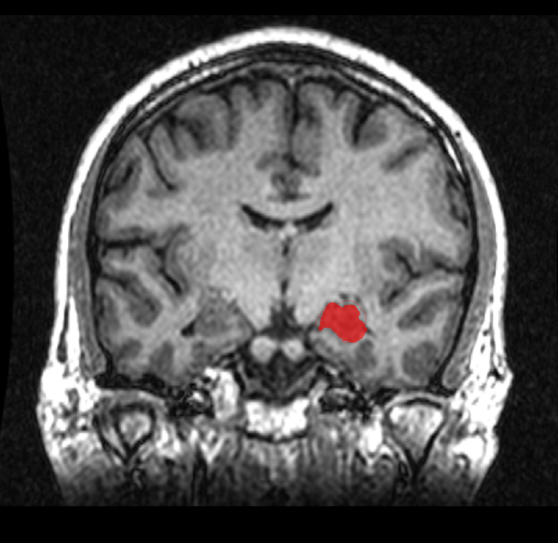 Imagen por resonancia magnética de un hipocampo (en rojo). Imagen: Amber Rieder/Jenna Traynor. Fuente: Wikipedia.