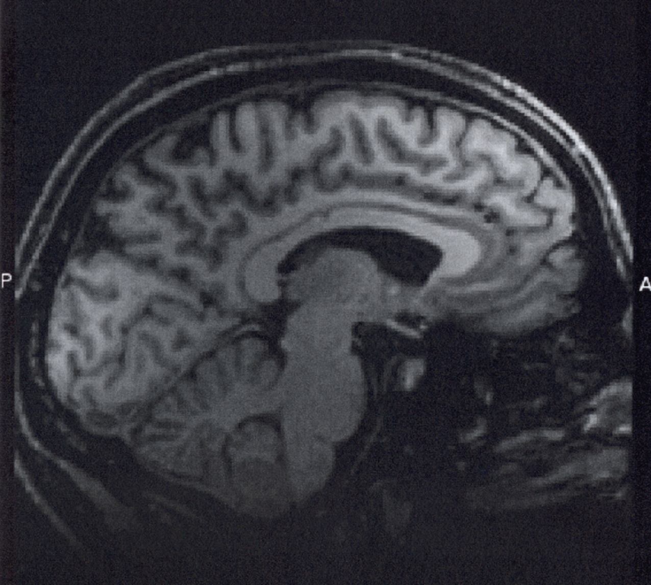 Resonancia magnética de cerebro. Imagen: Nathanial Burton-Bradford. Fuente: Flickr.