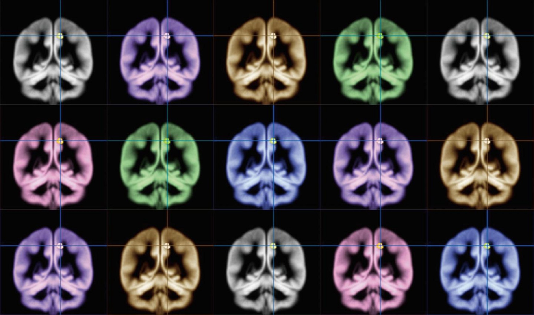 Científicos de la Universidad de Kioto usaron escáneres de imágenes de resonancia magnética para encontrar la localización de la felicidad en el cerebro. Fuente: Universidad de Kioto/Eurekalert!