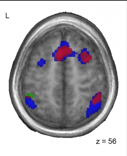 Patrones similares de actividad cerebral entre los bilingües chino-francés (rojo) y los adoptados (azul) cuando realizan una tarea con sonidos de francés. Imagen: Lara Pierce. Fuente: Universidad McGill.